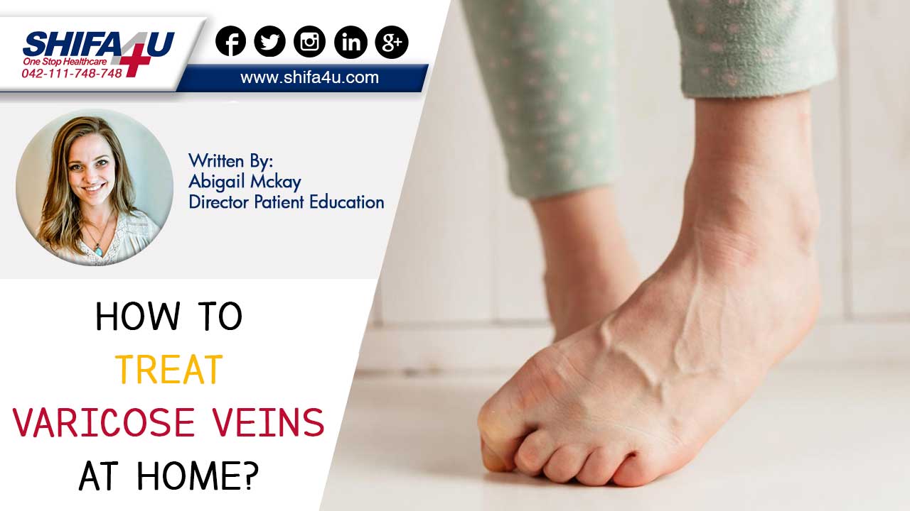 How to Treat Varicose Veins at Home?