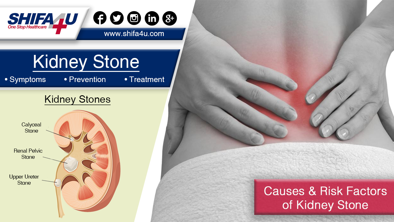 Kidney Stone Treatment Symptoms Prevention