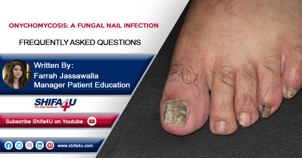 Diagnosis and Management of Onychomycosis (Tinea Unguium) with