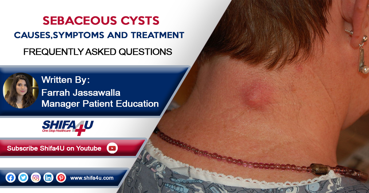 Sebaceous Cysts Causes Symptoms And Treatment 6526